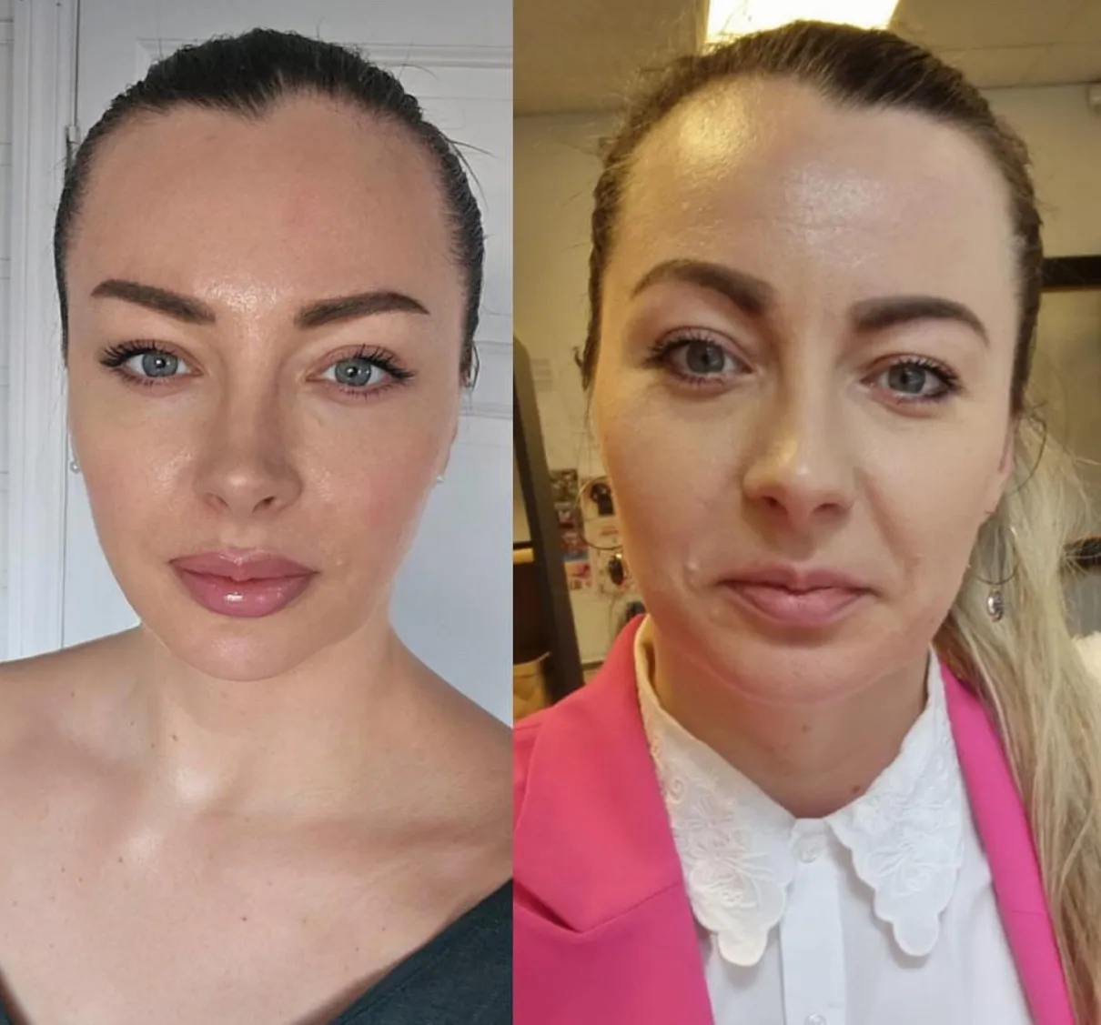 Anti aging rezultati pre i posle
