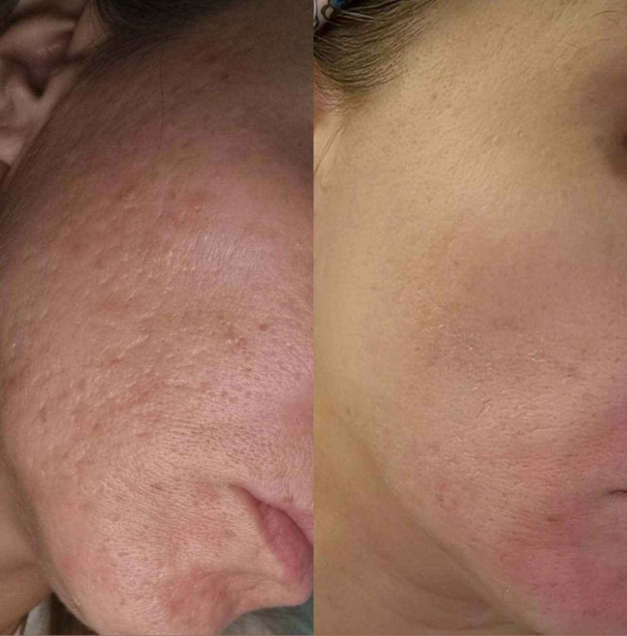 Skin pen pre i posle