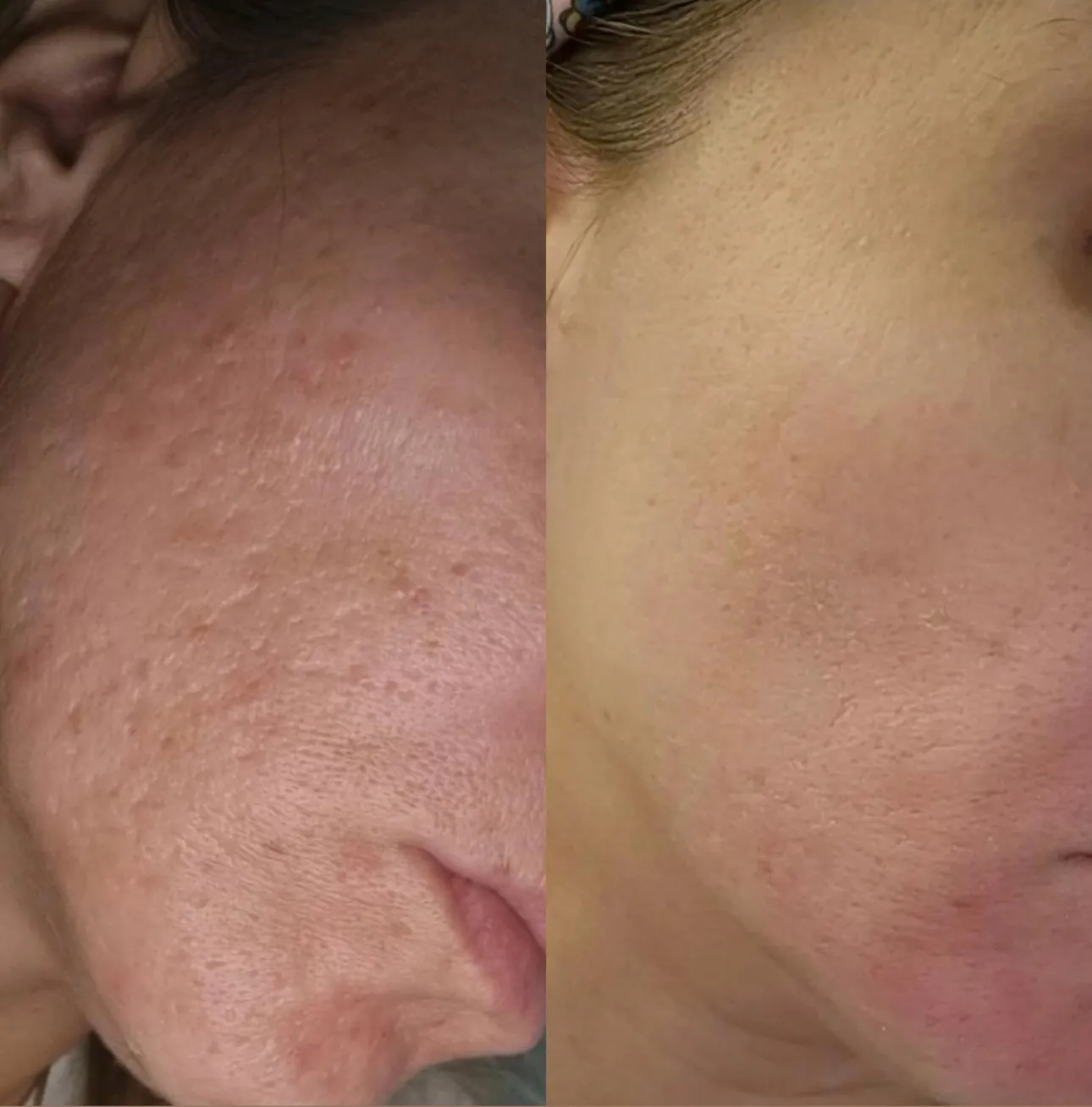 Skin pen pre i posle