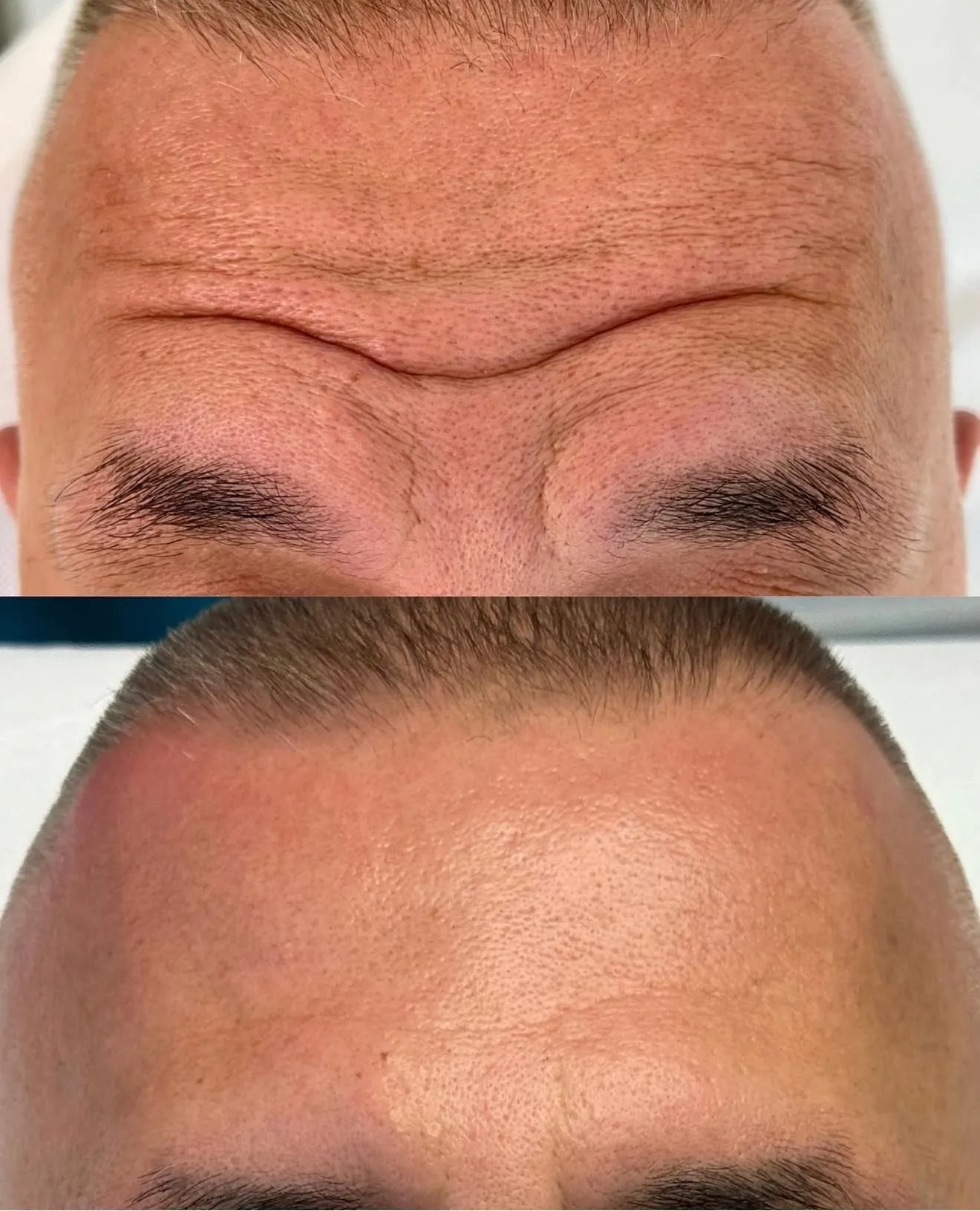 botox iskustva
