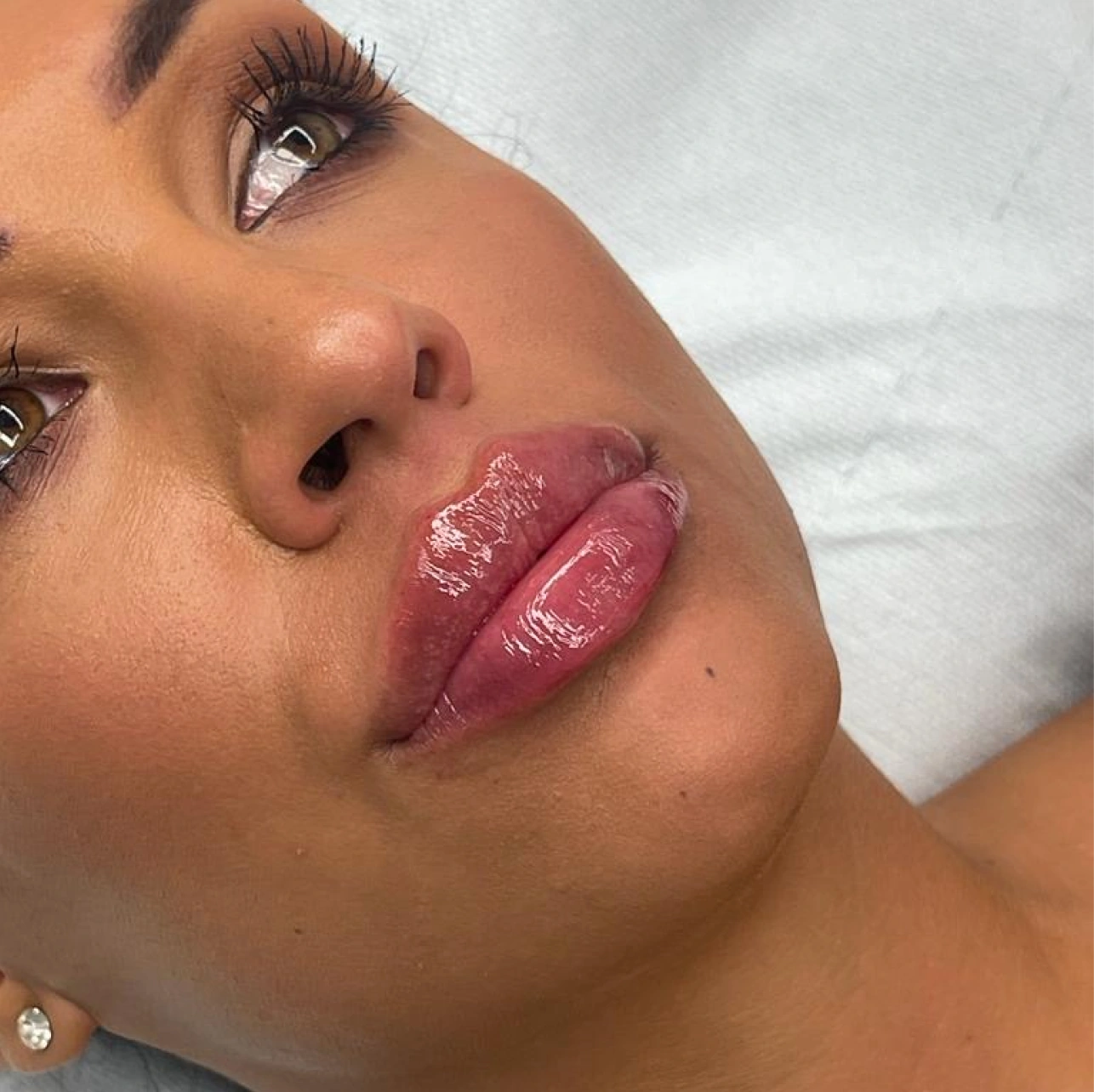 Rezultat estetskog tretmana filera na usnama sa naglašenim volumenom