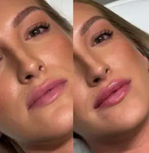 Povećanje usana hijaluronom - rezultati pre i posle