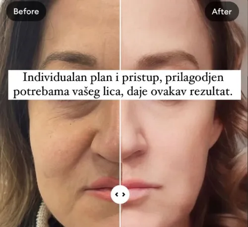 Lifting lica rezultat pre i posle Novi Sad - Dr Dalibor Kovacevic