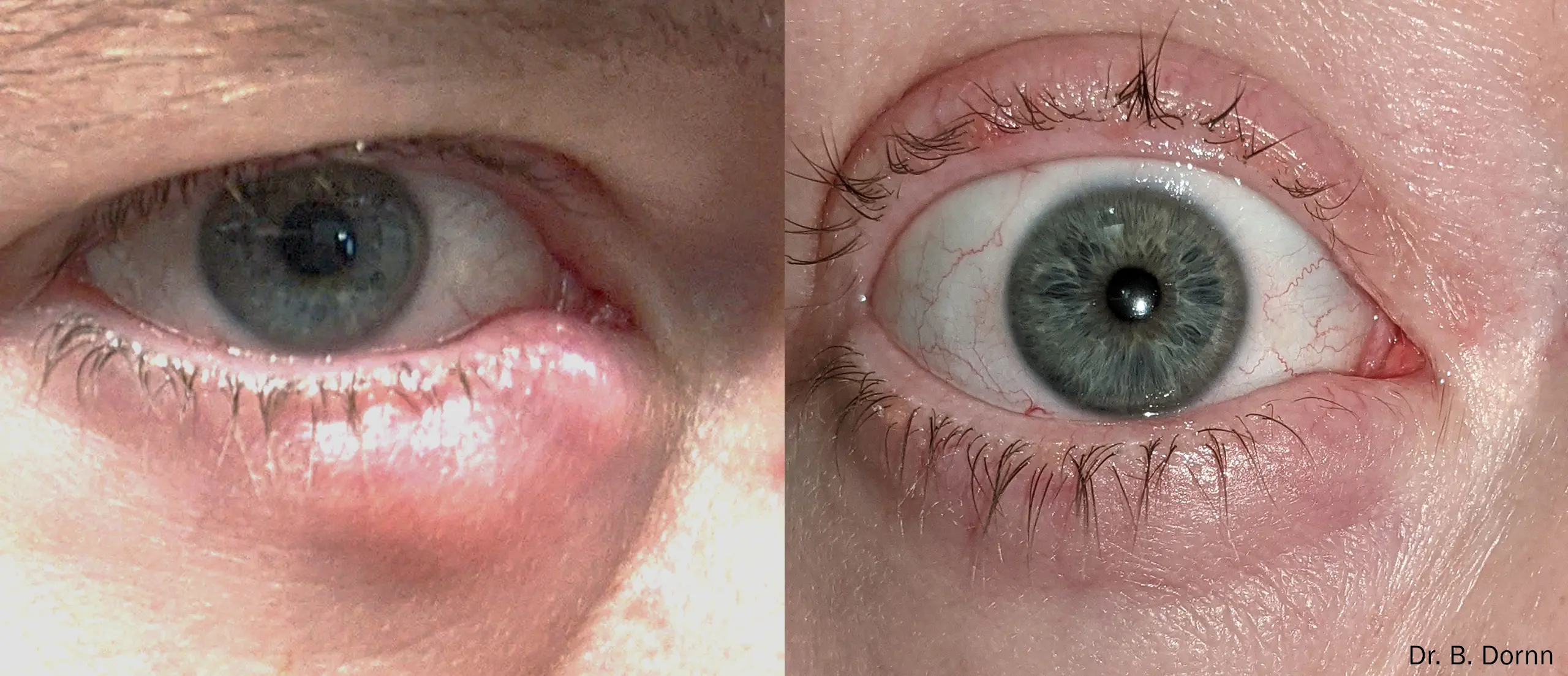 Before and after stye treatment with IPL and RF at Elite Eyecare Nashville — significant reduction in eyelid swelling and redness