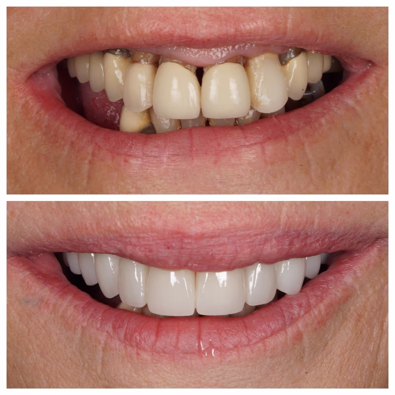 Porcelain Veneers
