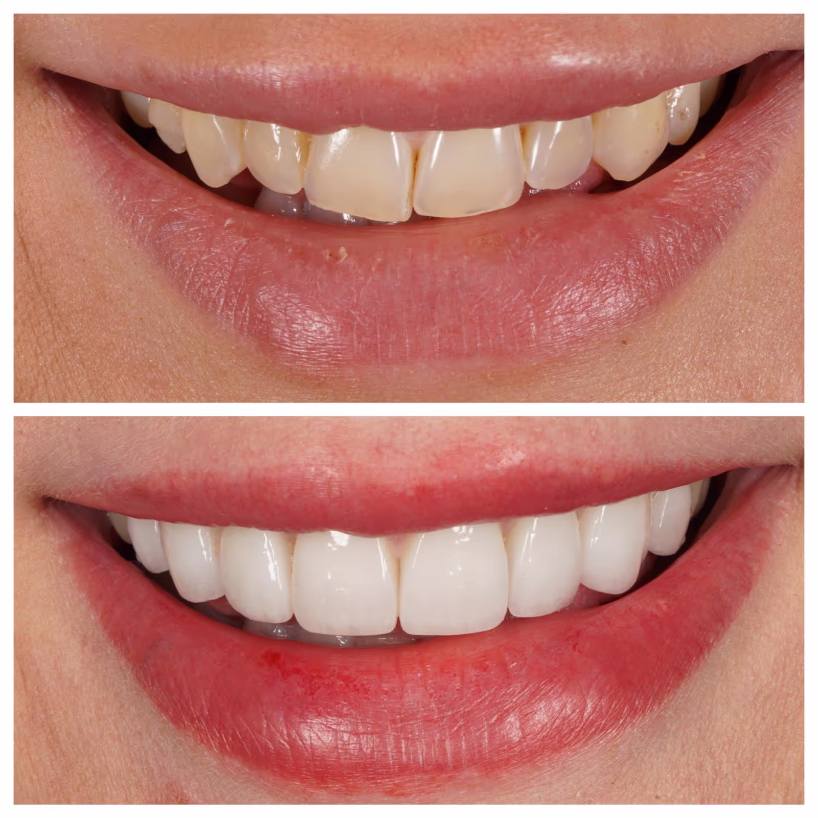 Porcelain Veneers