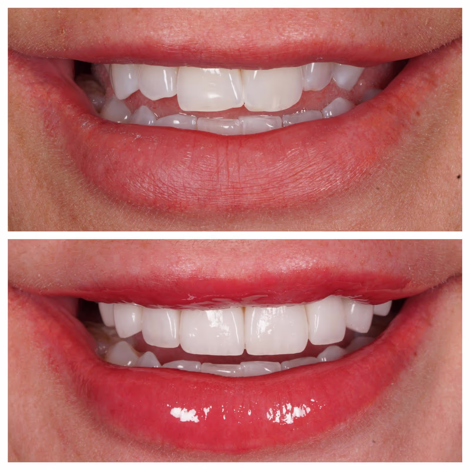 Porcelain Veneers
