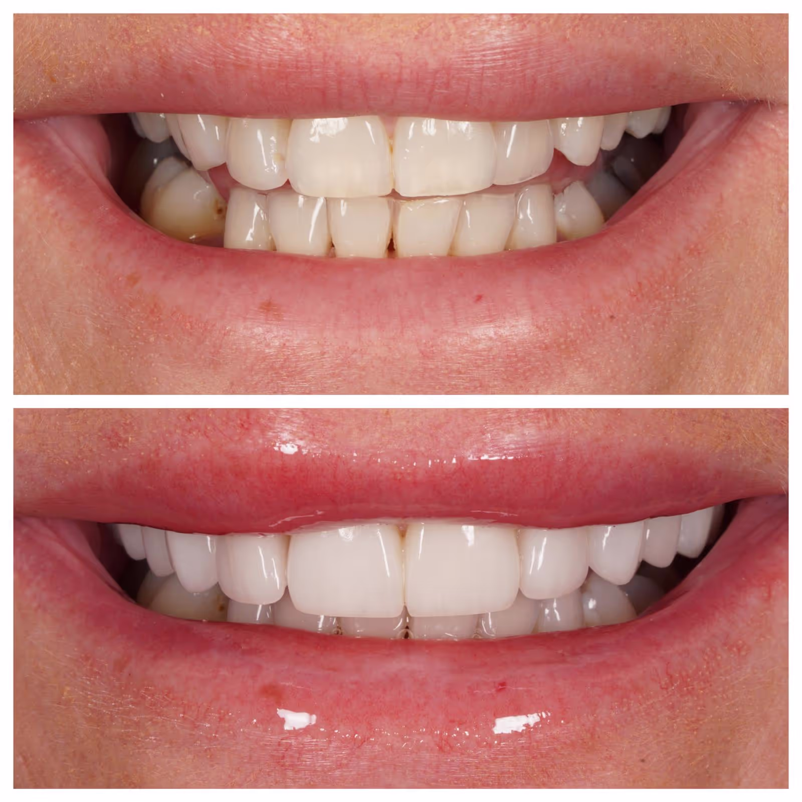 Porcelain Veneers