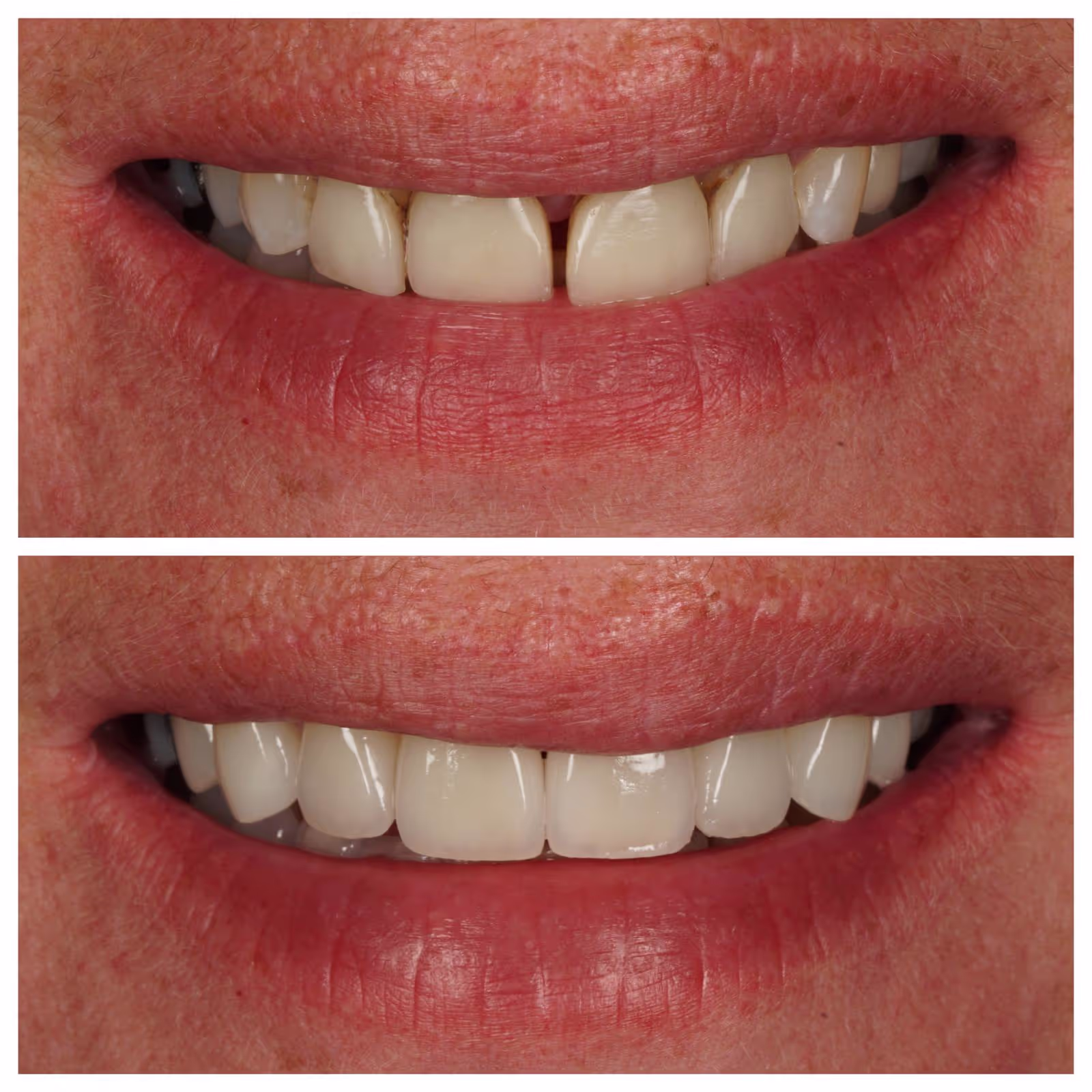 Porcelain Veneers