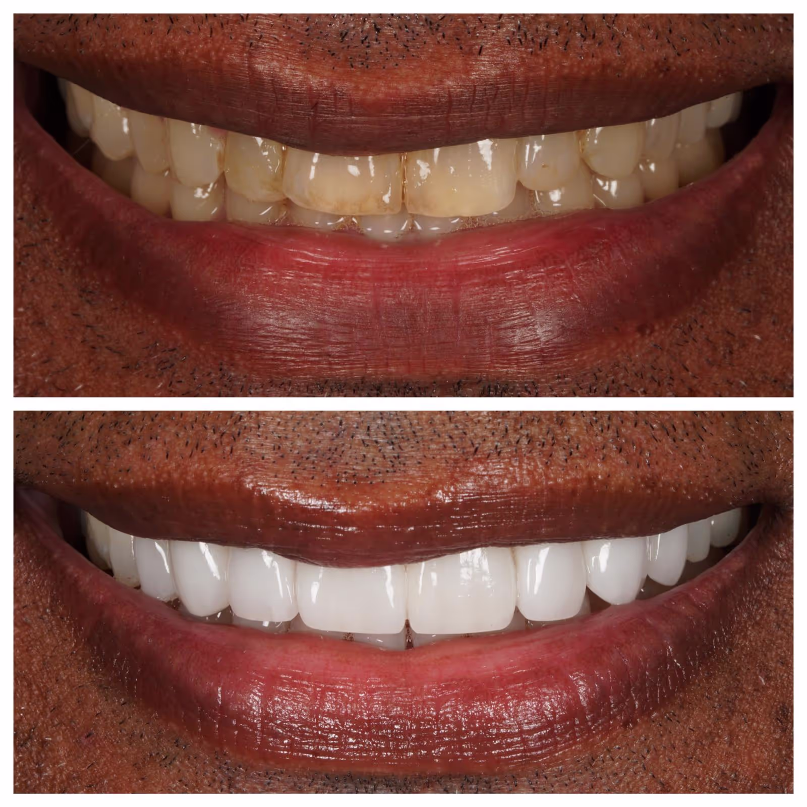 Porcelain Veneers