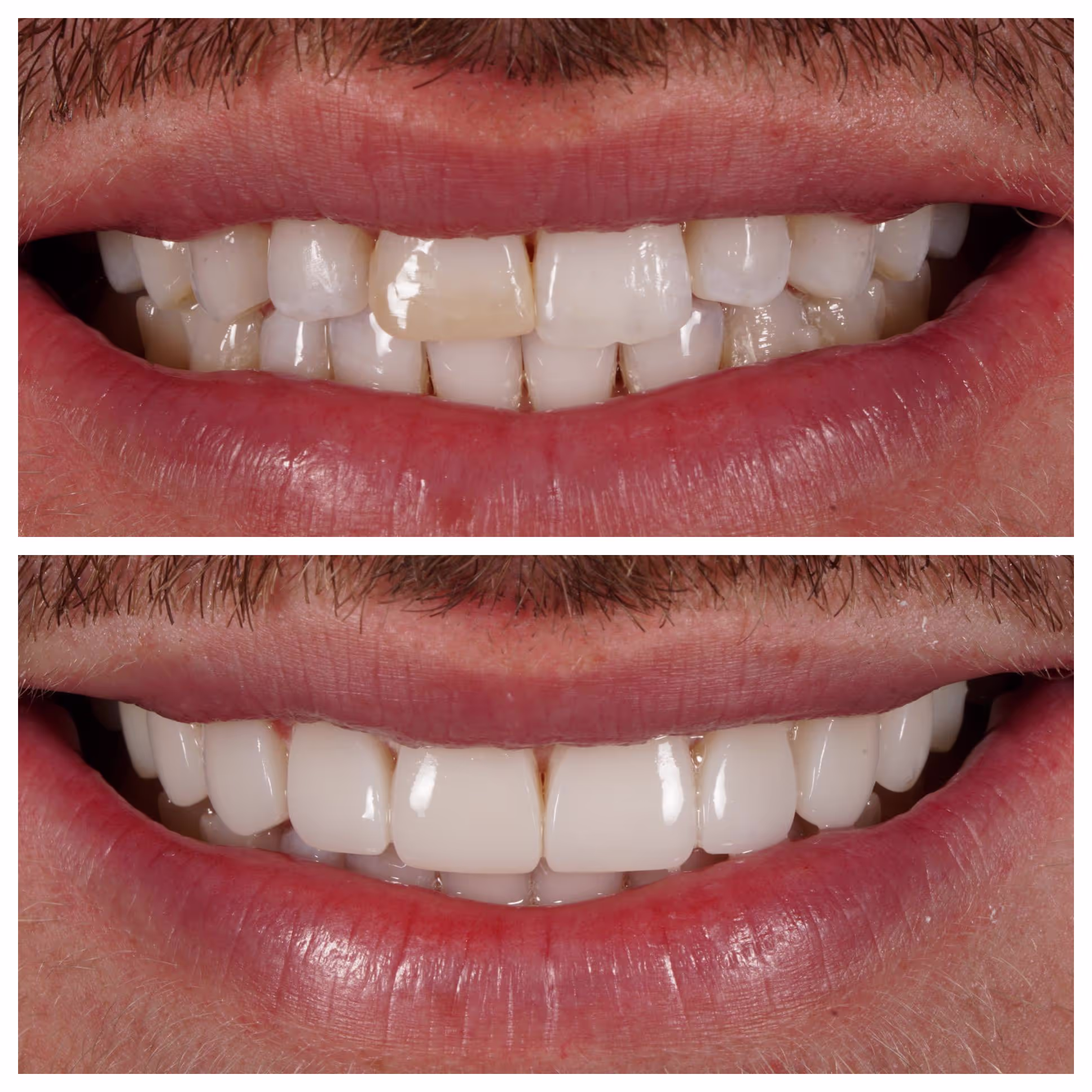 Invisalign