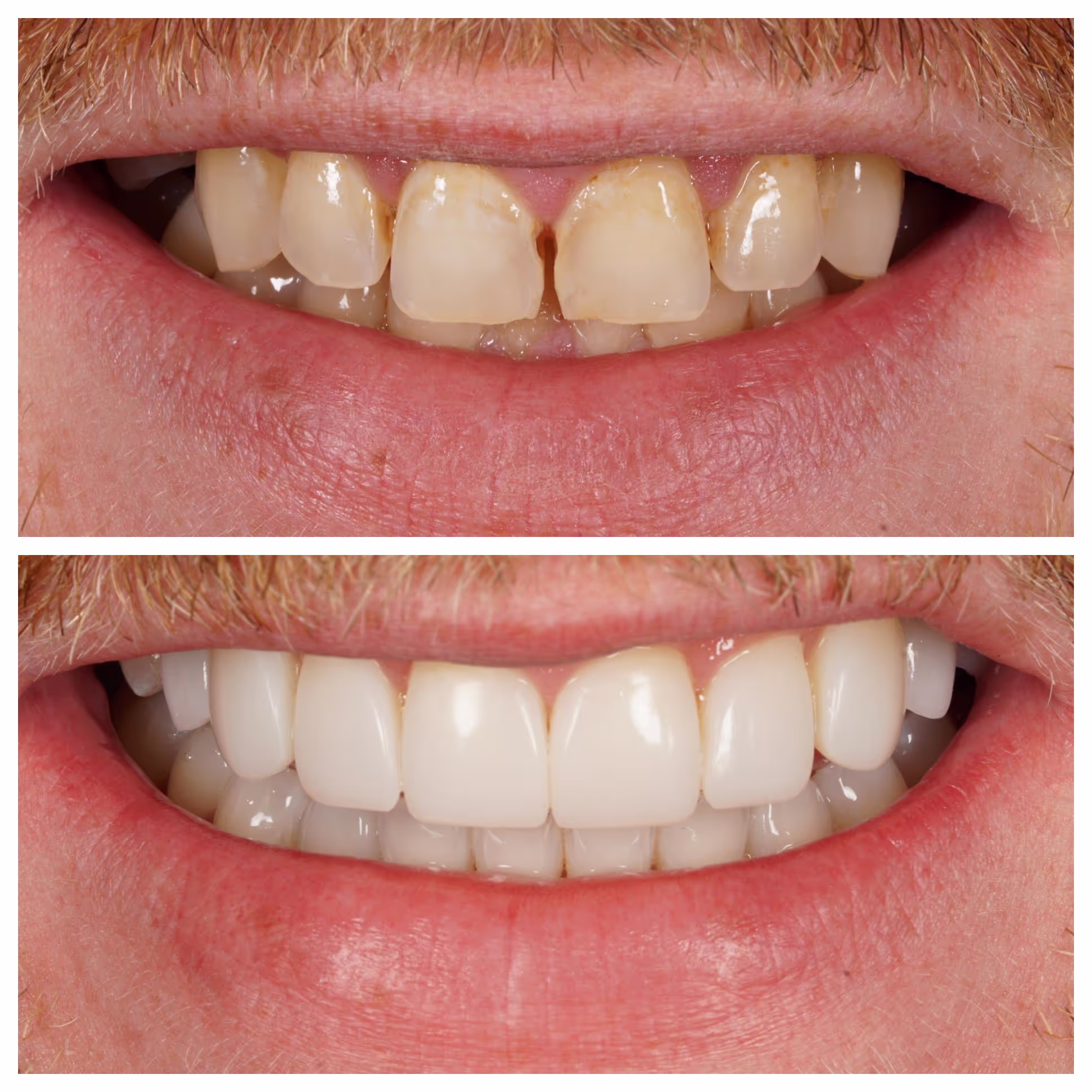 Invisalign