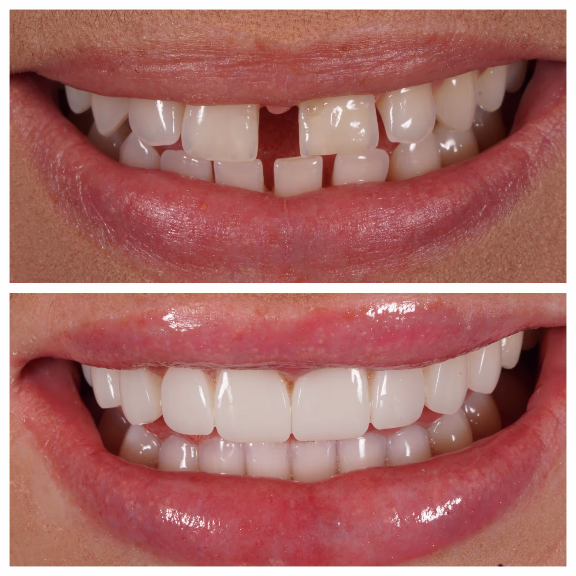 Invisalign
