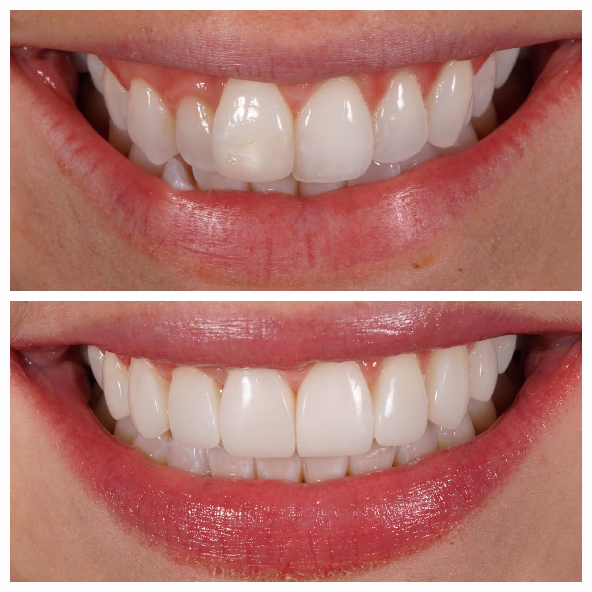 Invisalign