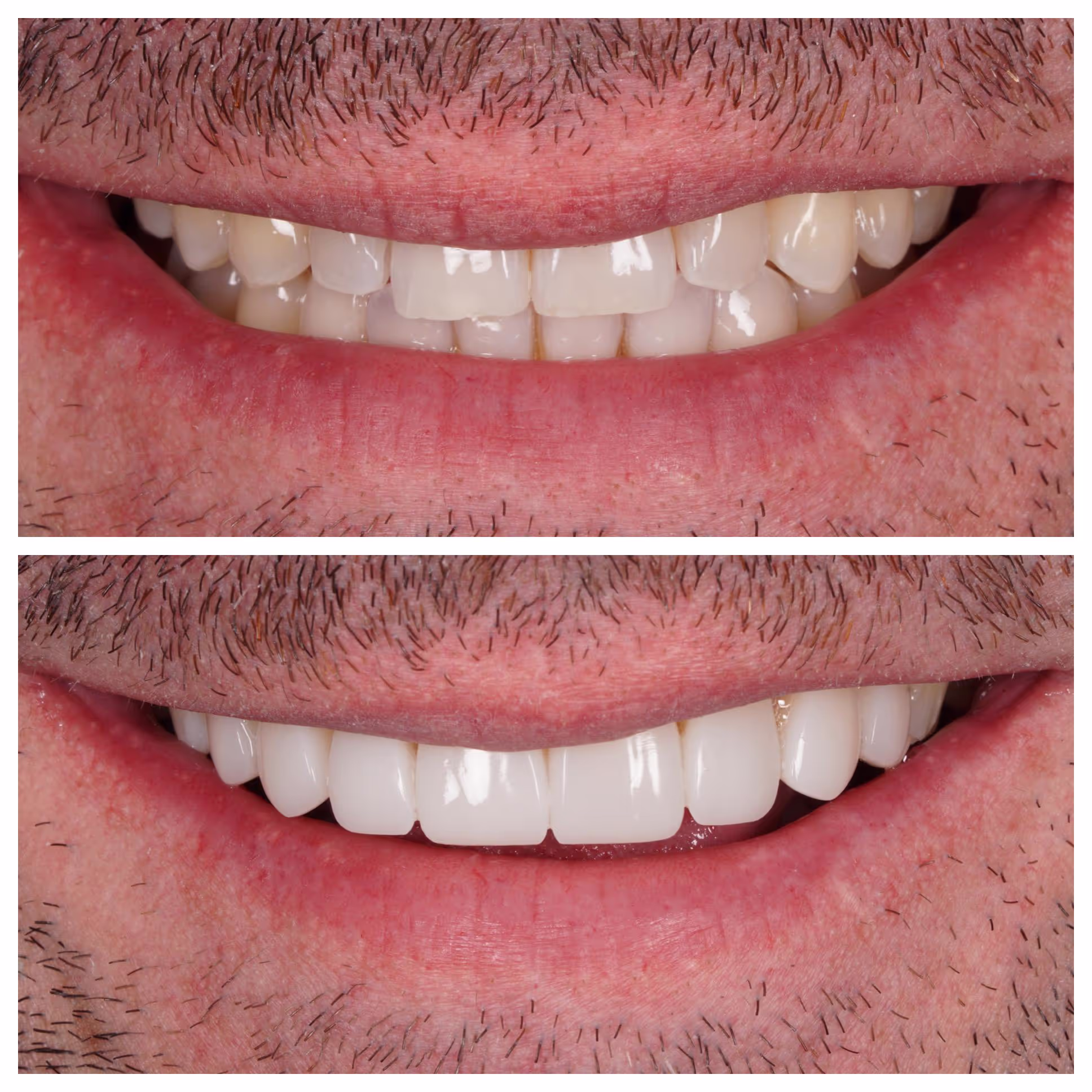 Invisalign