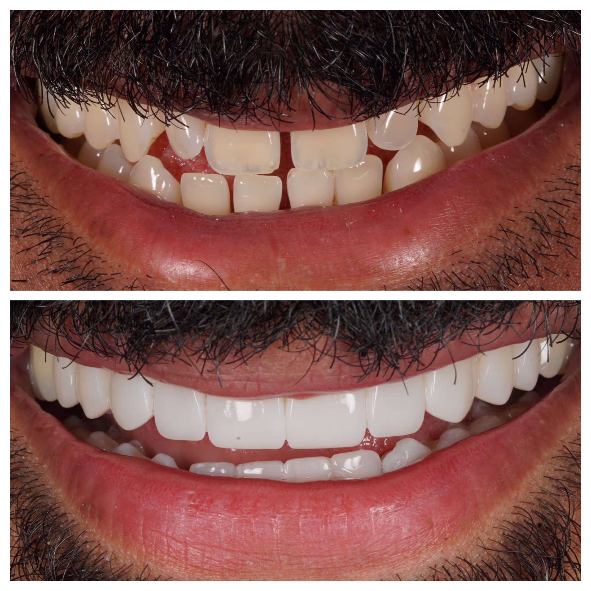 Invisalign