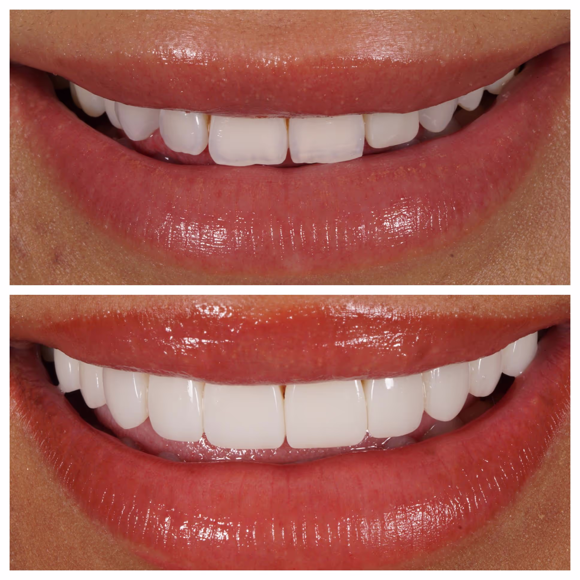 Composite Bonding