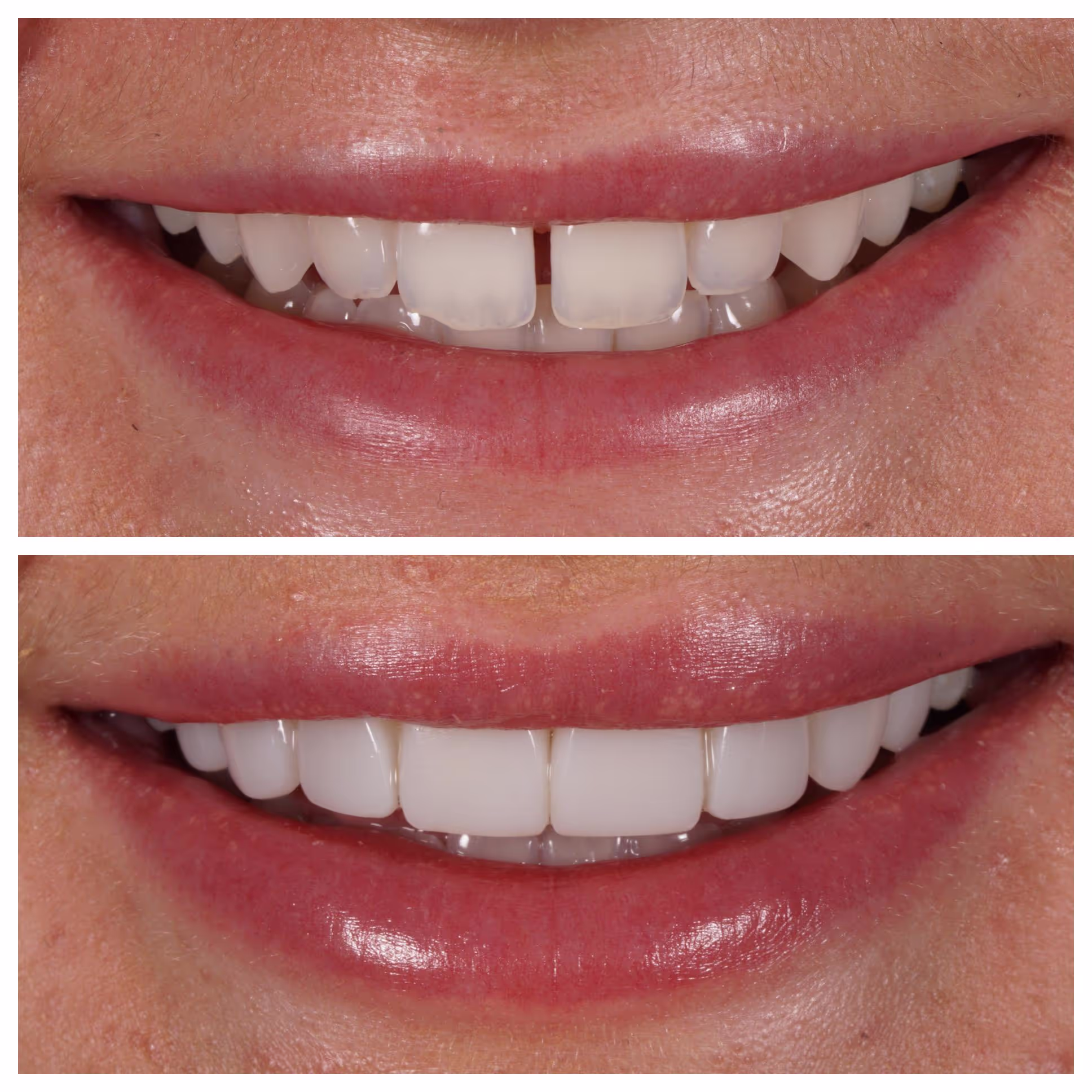 Composite Bonding