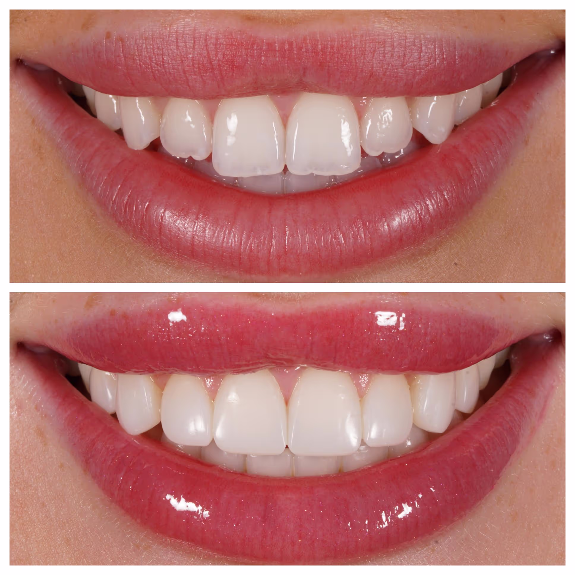 Composite Bonding