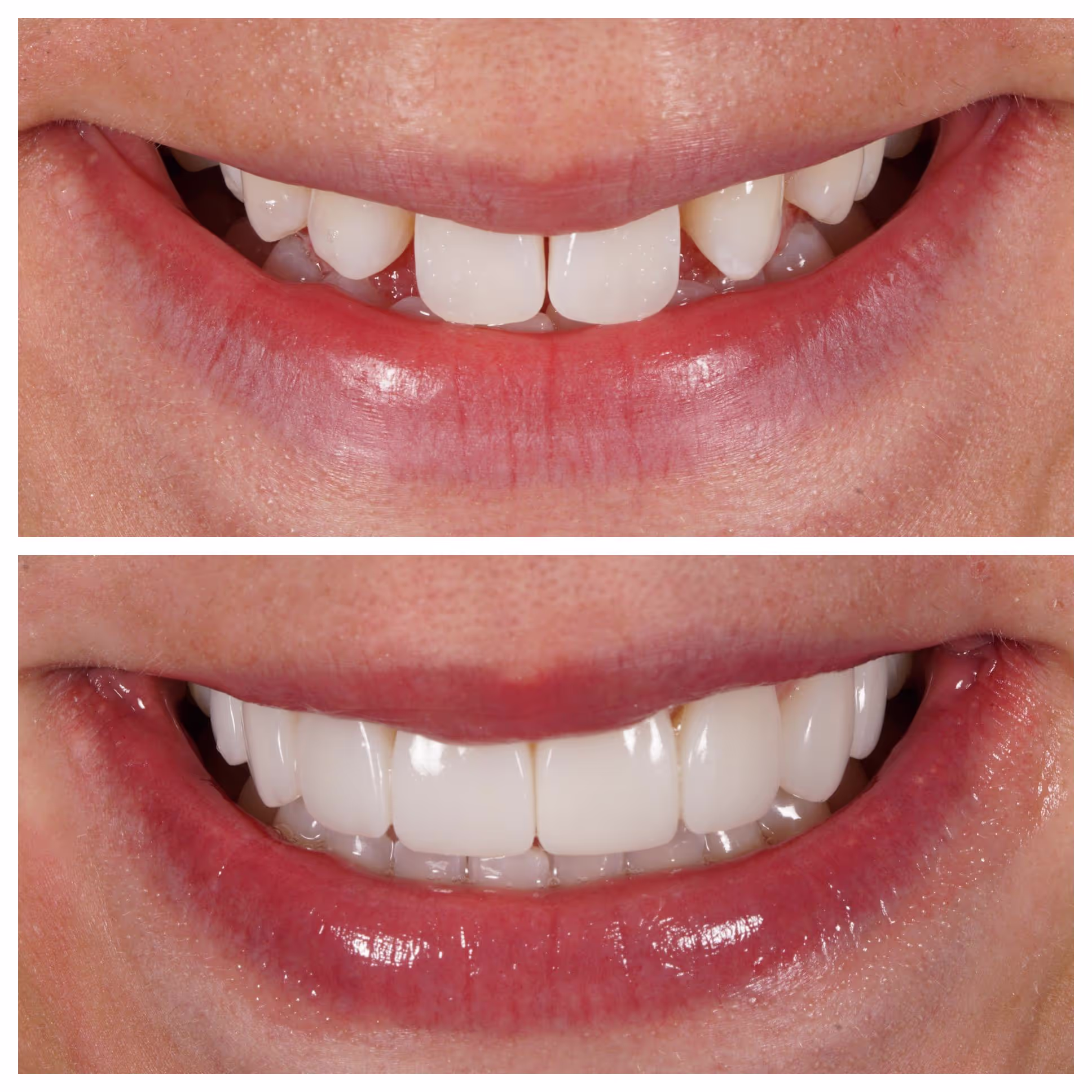 Composite Bonding