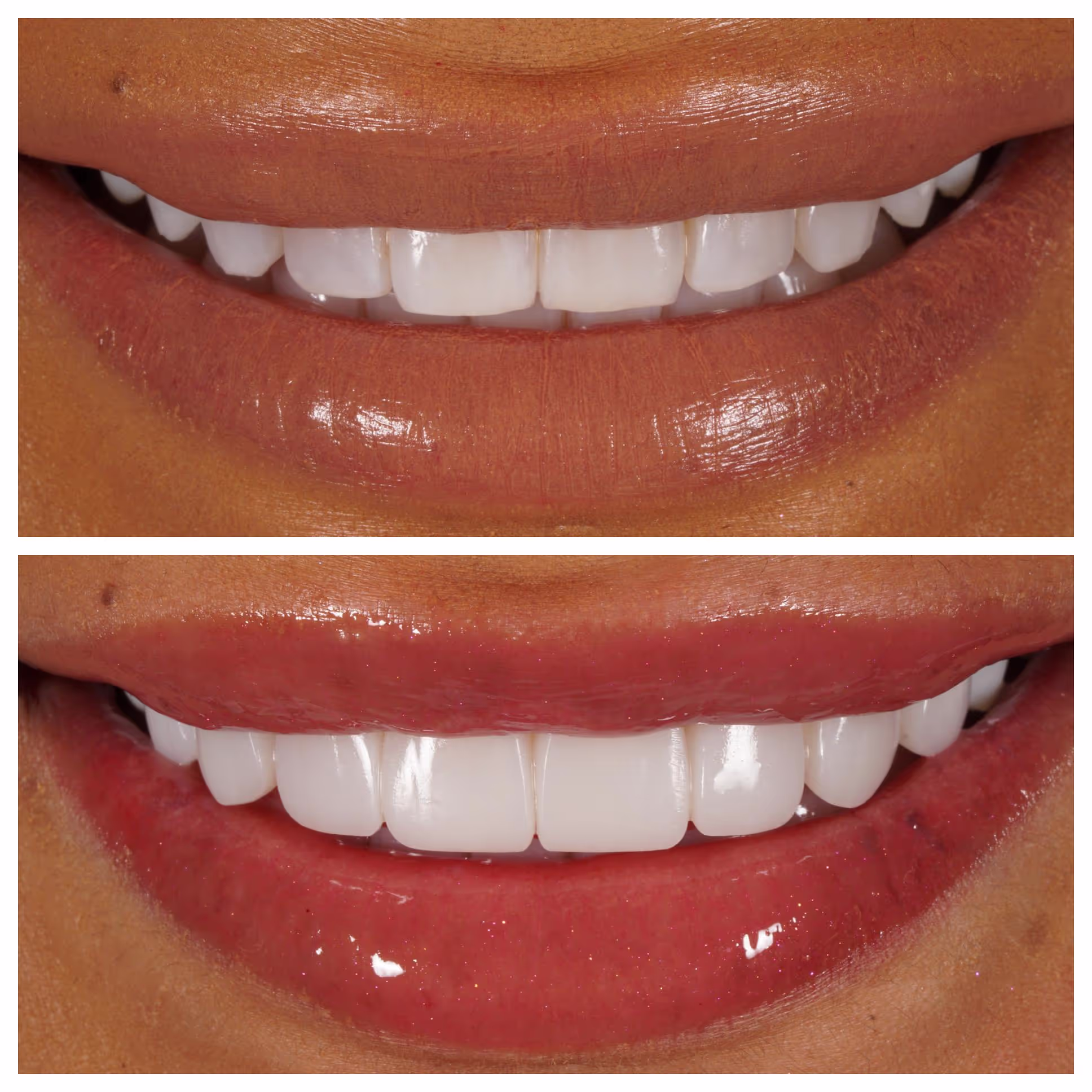 Composite Bonding