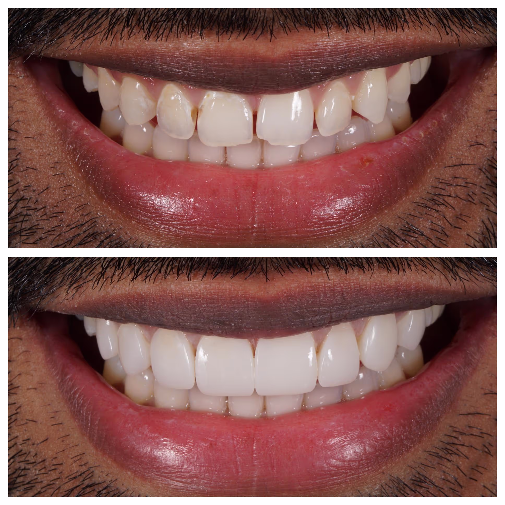 Composite Bonding