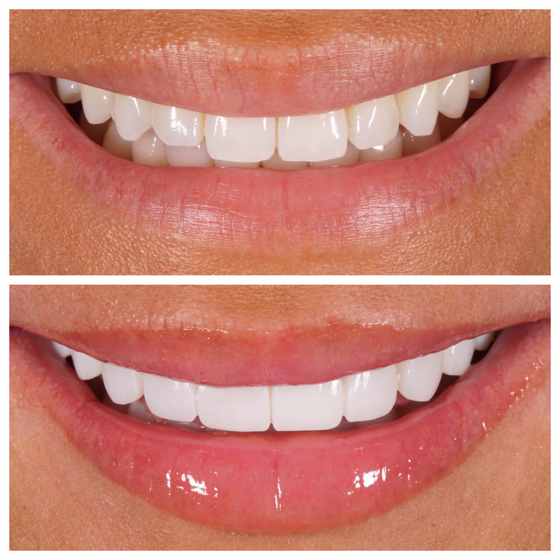 Composite Bonding
