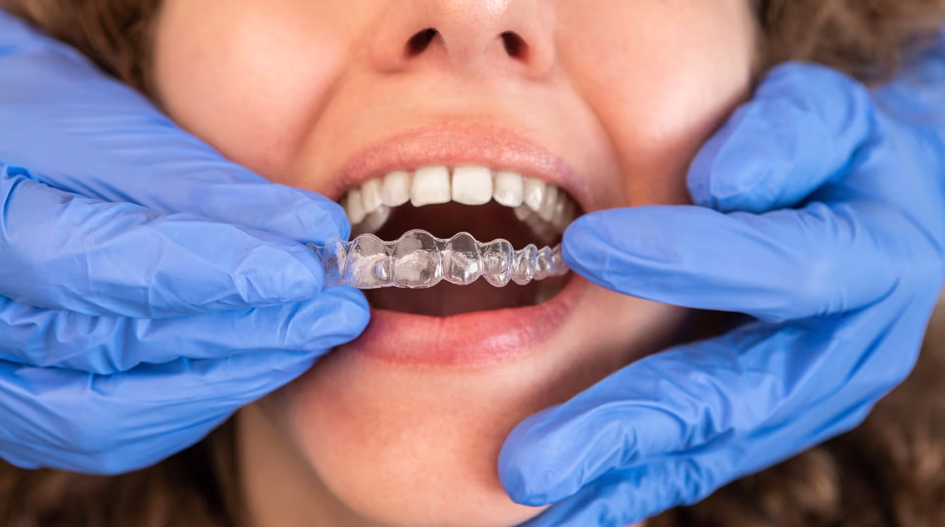 Invisalign
