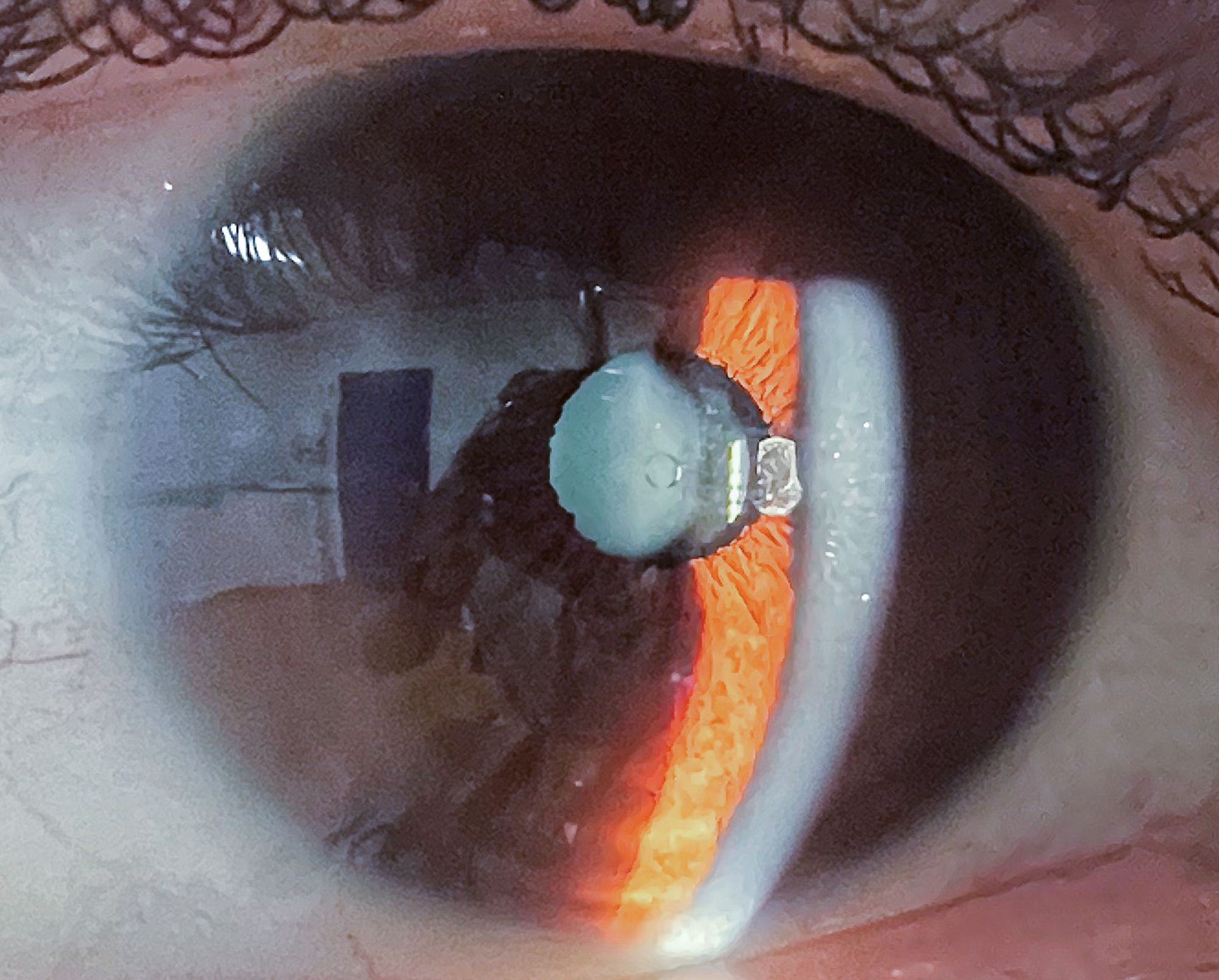 Phake Rankaile Phake Intraokularlinsen | EyeZurich