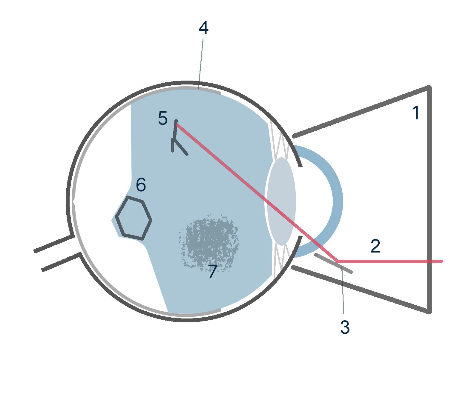 Laser-Vitreolyse