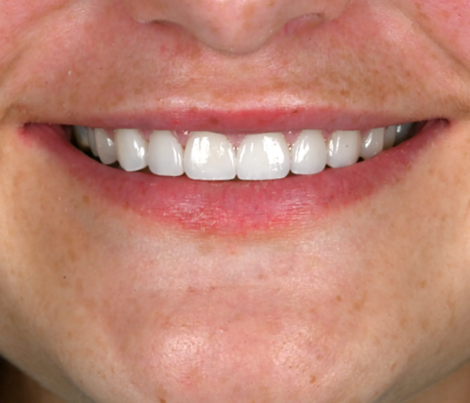 Smiling man in dental chair with a dental shade guide held against his teeth by gloved hands.