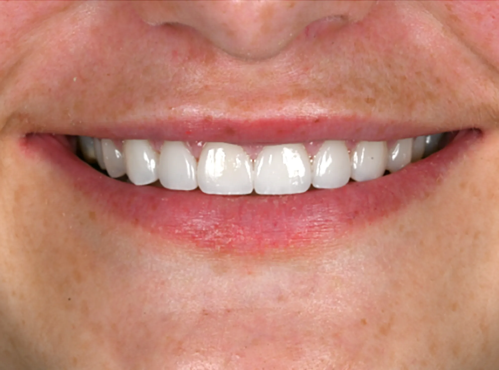 After Dental Procedure