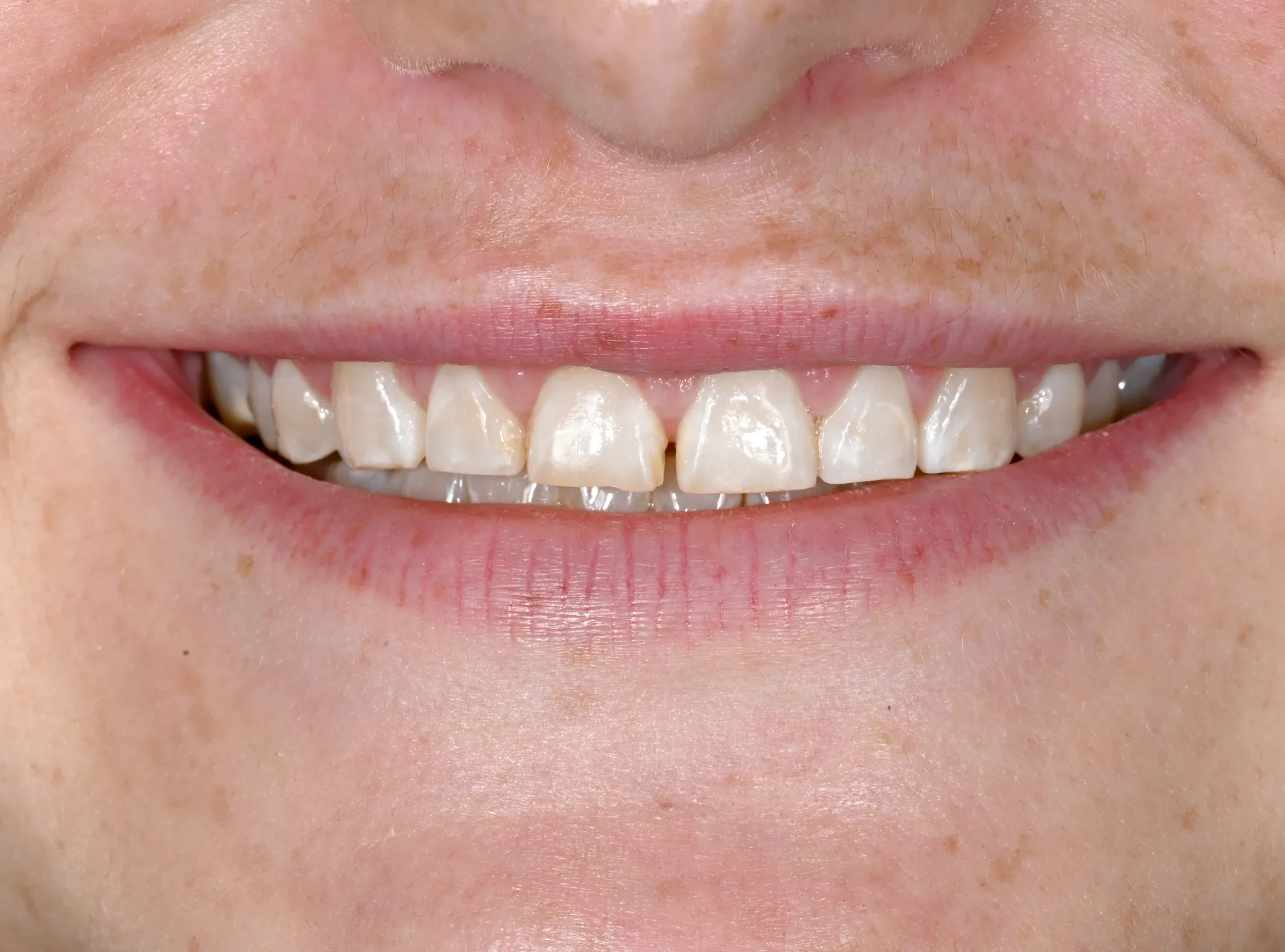 Before Dental Procedure