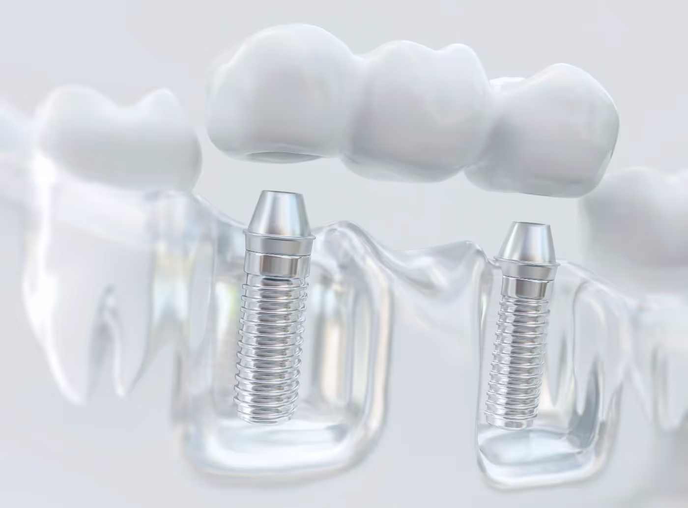 Dental Implant Restorations in Point Loma | Danielle McCourt DDS