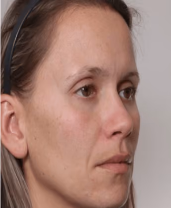 Laser hair removal all skin types Beverly Hills