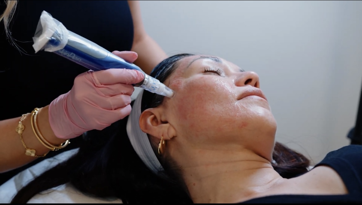 A SkinPen microneedling device is used on a client’s cheek at LYEV Beverly Hills.