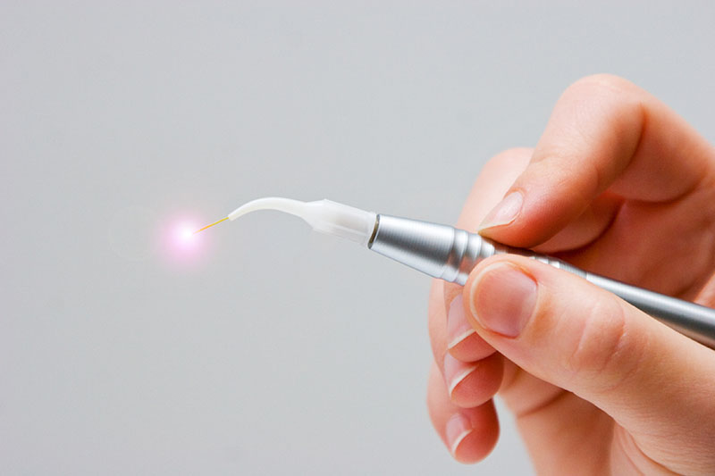 Laser Dentistry in Los Altos