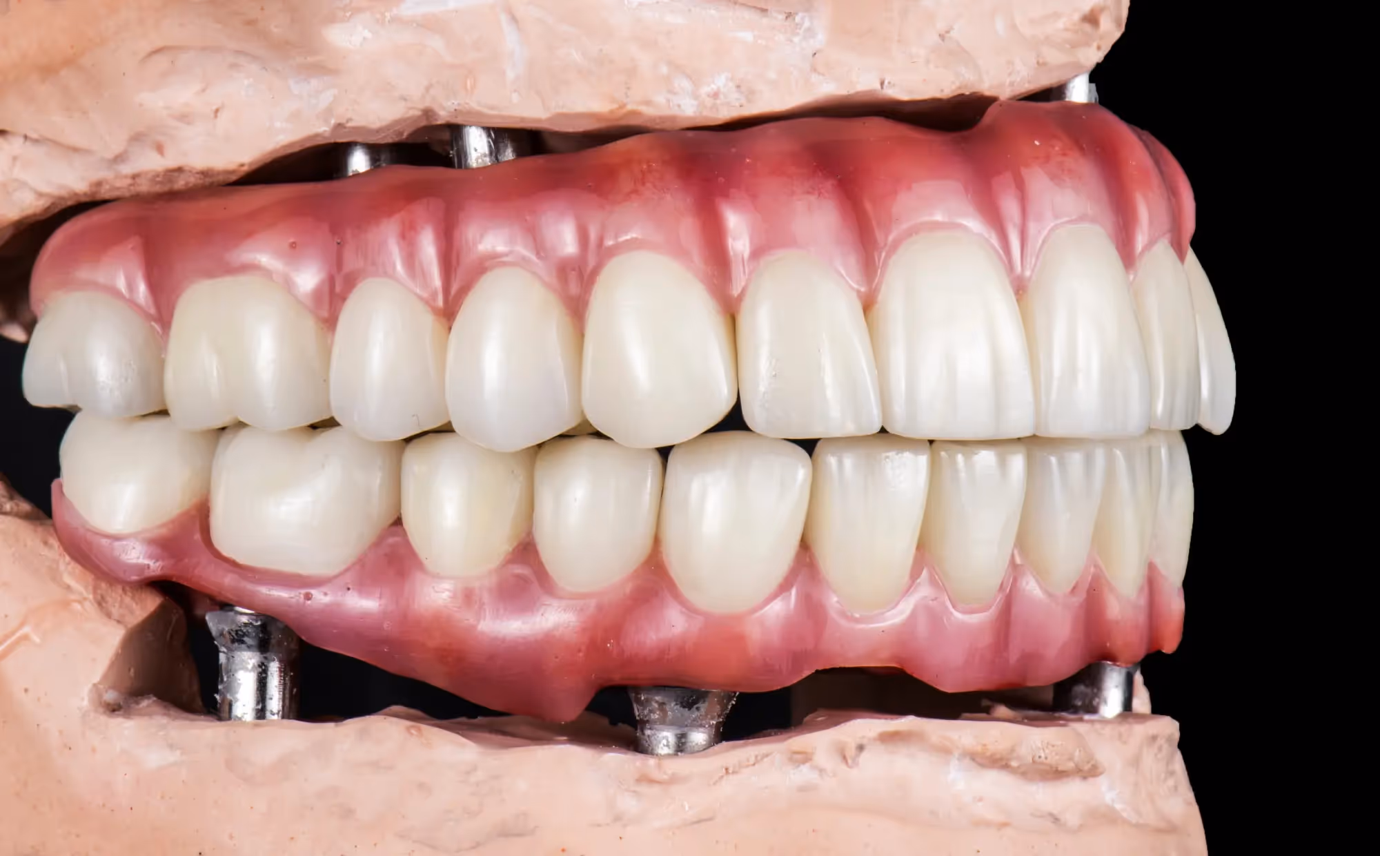 All-on-X Implants in Seattle