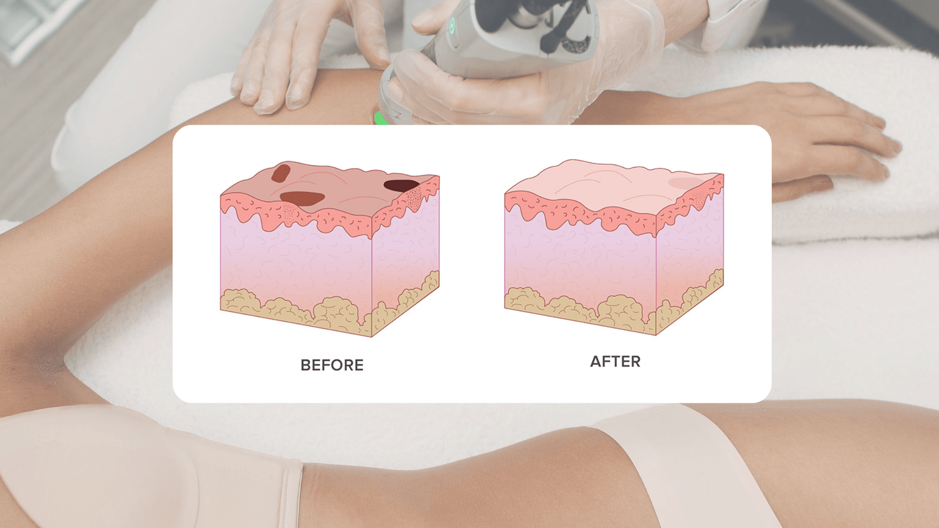 Is laser hair removal actually permanent?