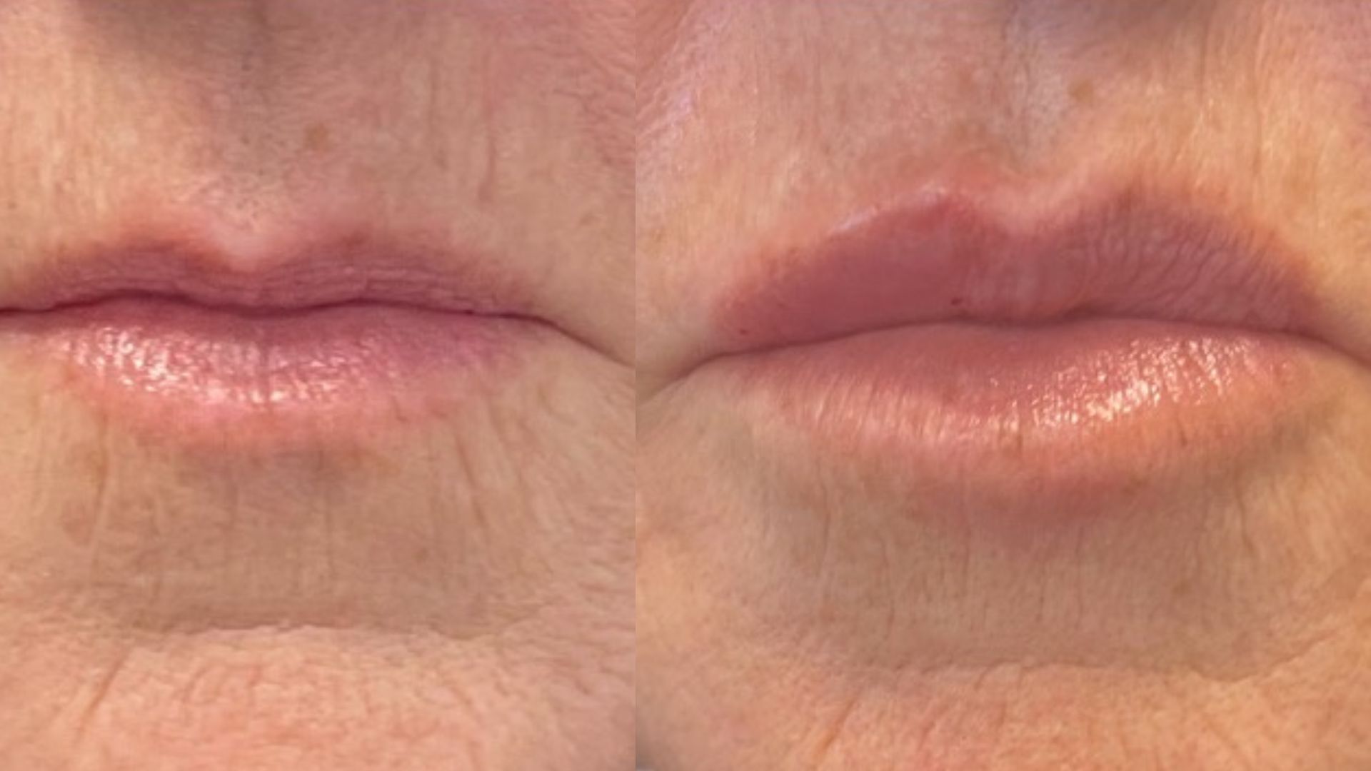Thinking About Filler? Here’s What to Know Before Your First Filler Appointment