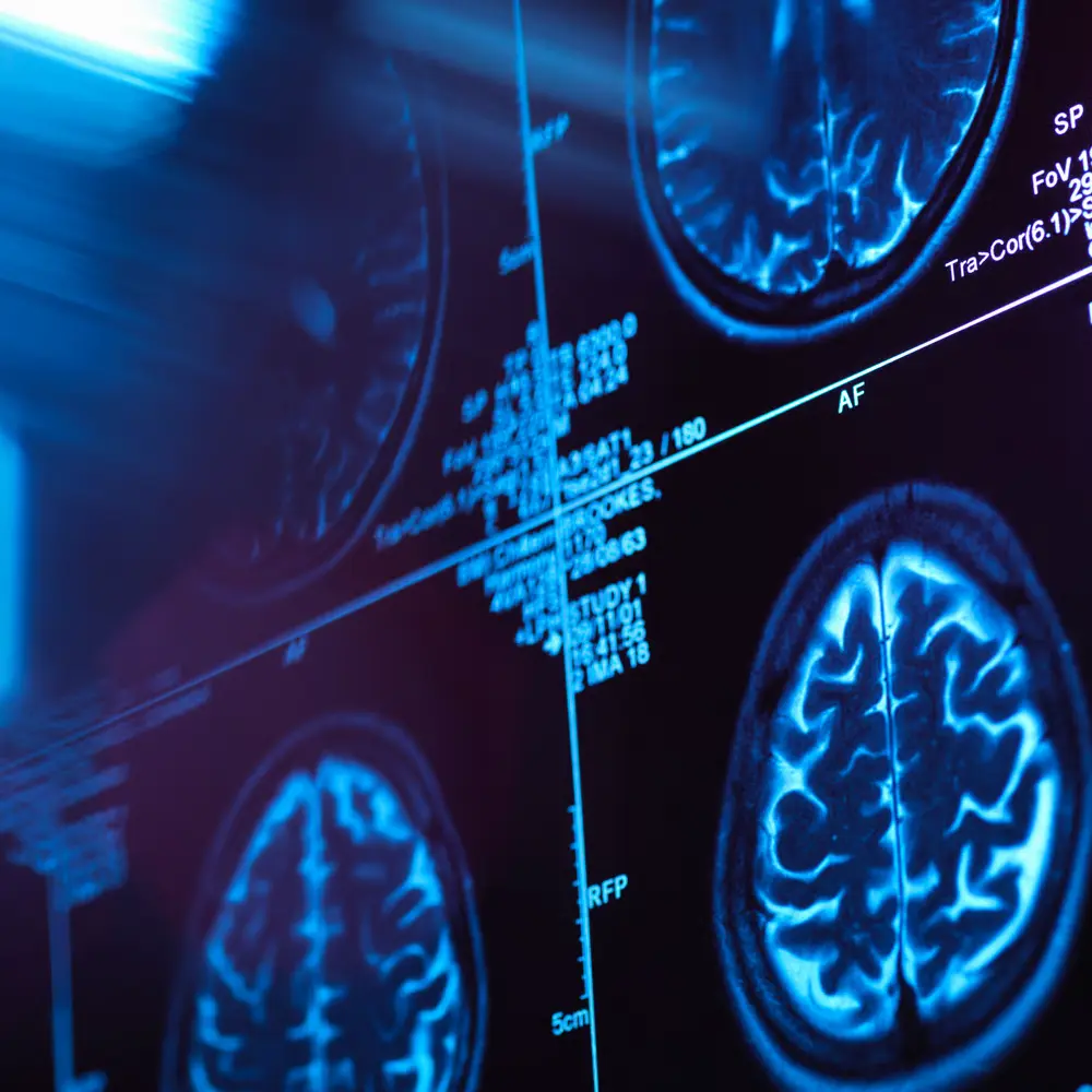 Medical brain scans and diagnostic imaging displayed on a computer screen for precision healthcare analysis.