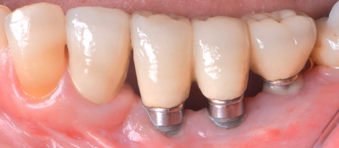 1 In 5 Implant Carriers Will End Up Developing A Peri-implant Disease