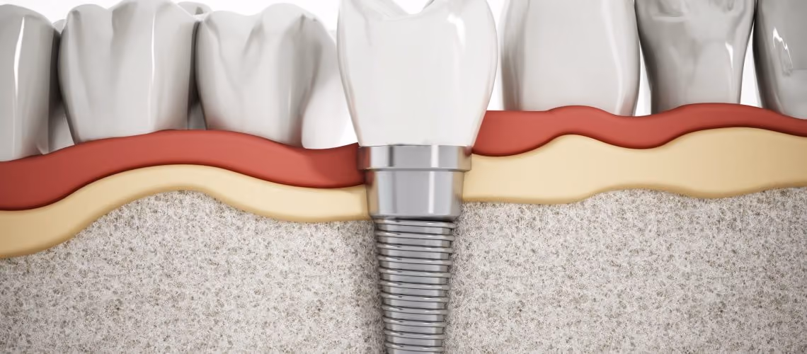 How Long Do Dental Implants Last?