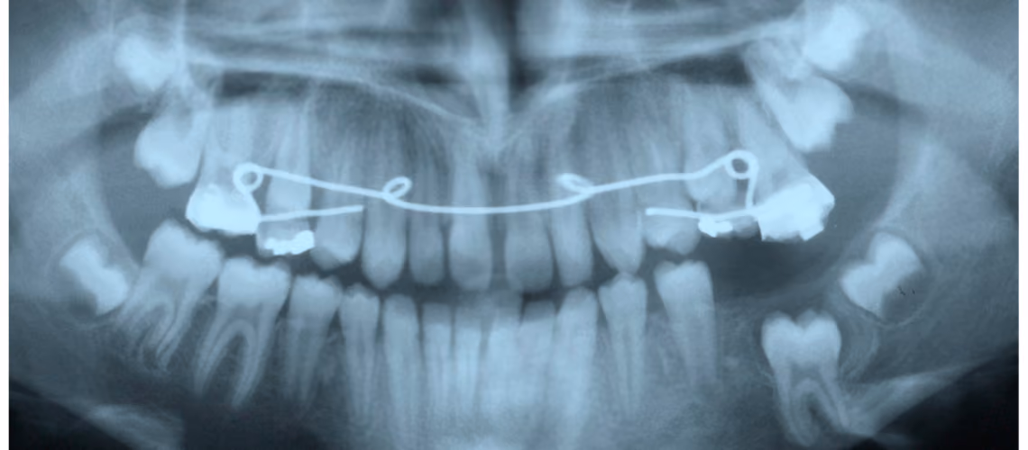 Canine Fenestration: When The Teeth Do Not Erupt Well