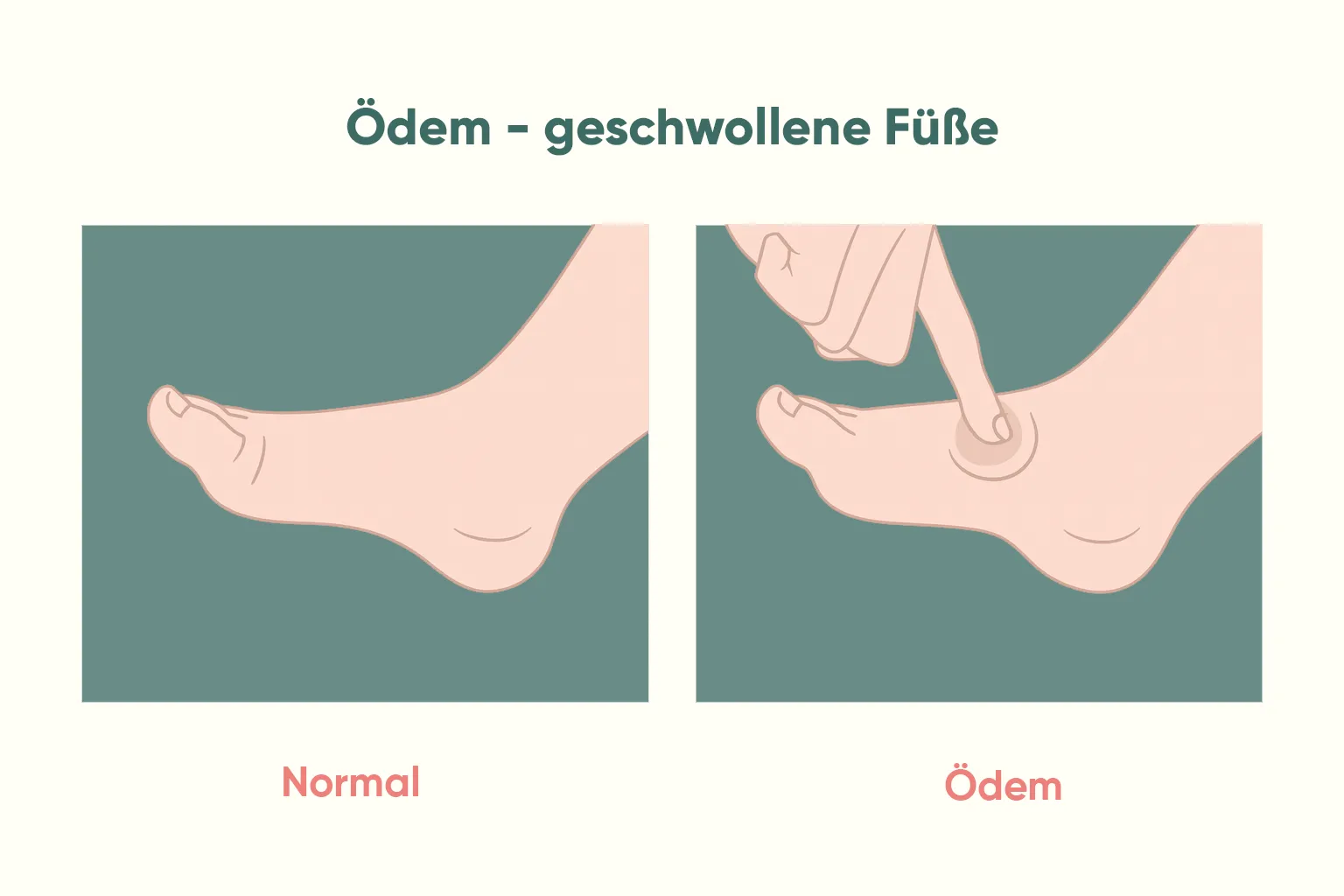 Grafische Darstellung eines normalen Fußes und eines geschwollenen Fußes mit Ödem, die zeigt, wie Abnehmen Wassereinlagerungen im Körper reduzieren kann.