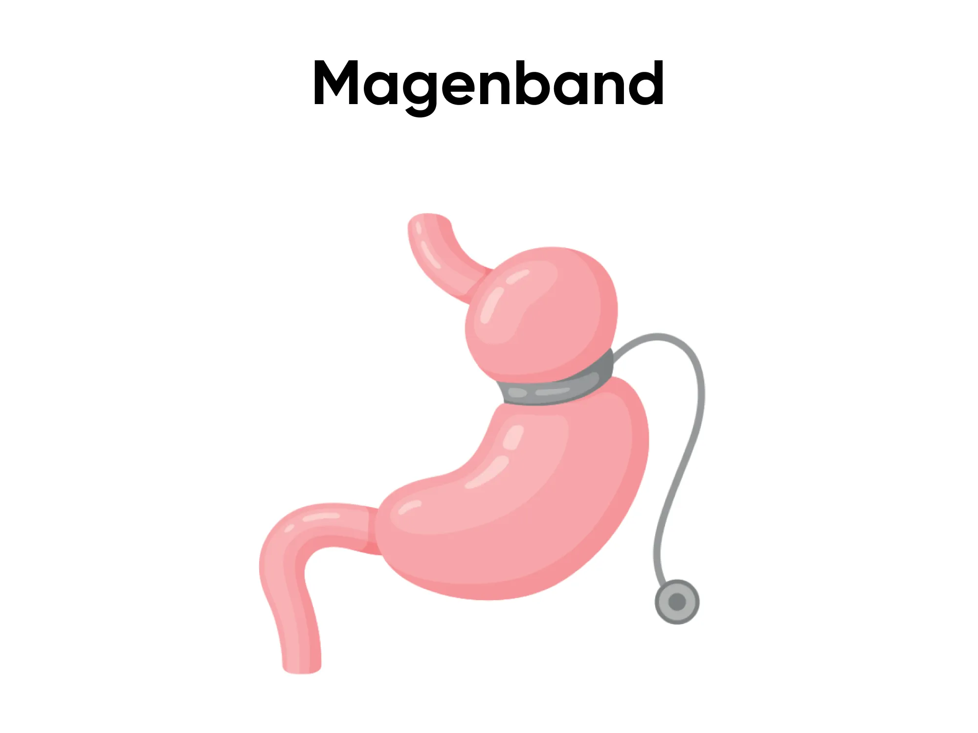 Magenband Operation als effektive Maßnahme zur Gewichtsreduktion bei Adipositas