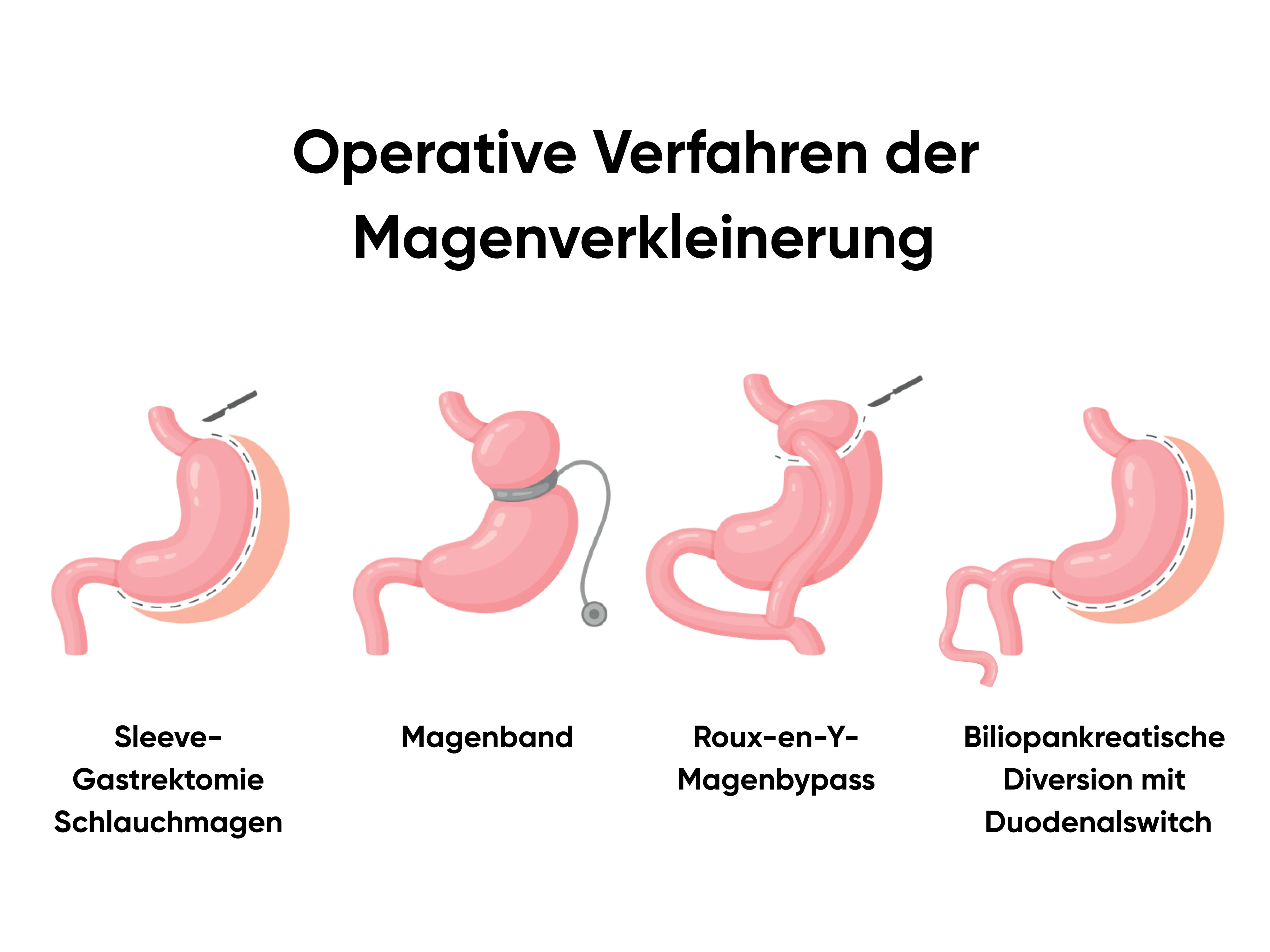 Grafische Übersicht verschiedener chirurgischer Verfahren der Magenverkleinerung, die die gängigen Operationsmethoden zur Magenverkleinerung anschaulich nebeneinander darstellt.