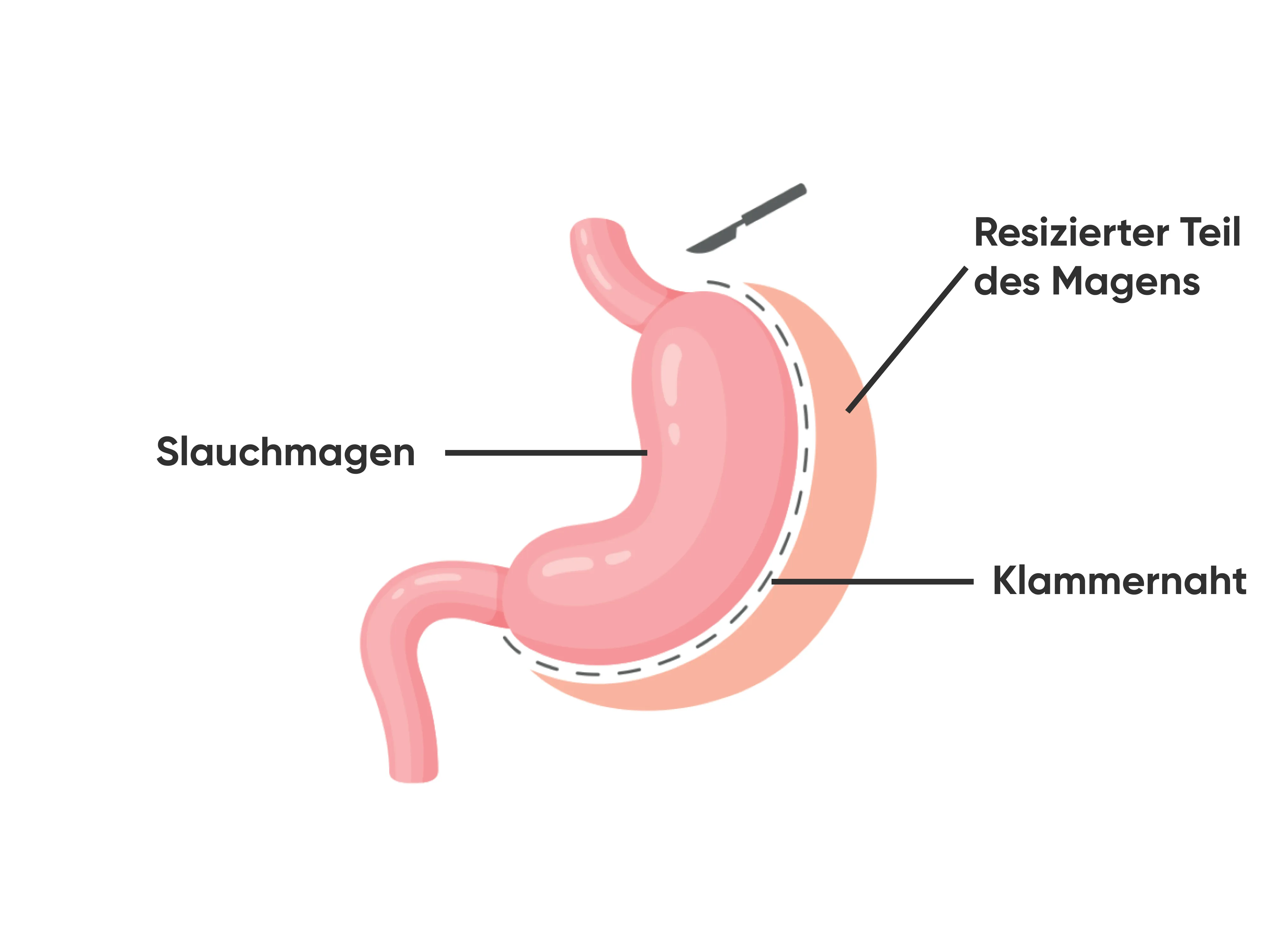 Grafische Darstellung eines Schlauchmagen-Eingriffs, bei dem der Magen zu einem schmalen Schlauchmagen geformt und der entfernte Teil markiert ist.