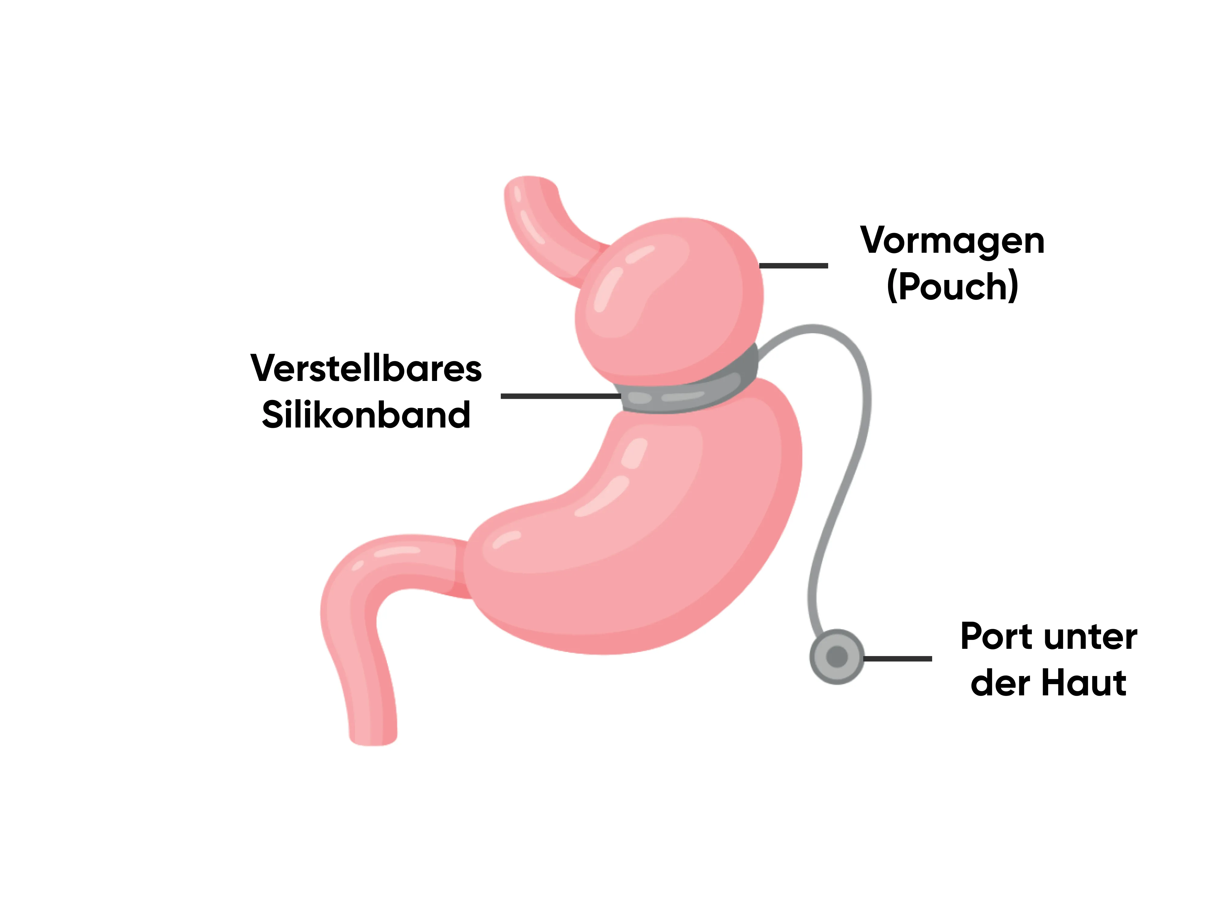 Infografik zum magenband mit Darstellung von Vormagen (Pouch), verstellbarem Silikonband und Port unter der Haut zur operativen Behandlung von starkem Übergewicht.