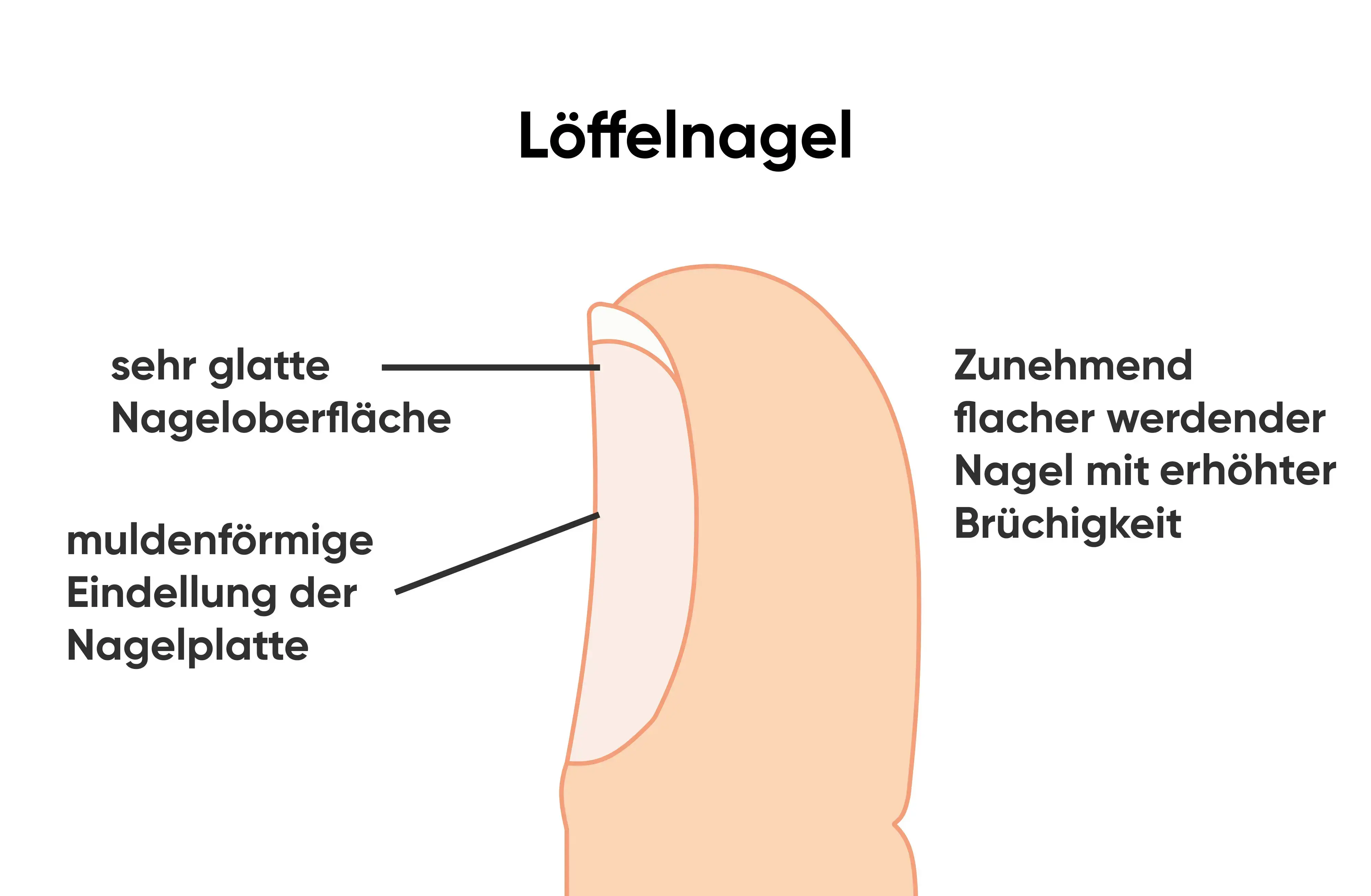 Infografik eines Löffelnagels mit sehr glatter, muldenförmig eingedellter Nagelplatte und erhöhter Brüchigkeit als mögliche Folge bei Eisenmangel .